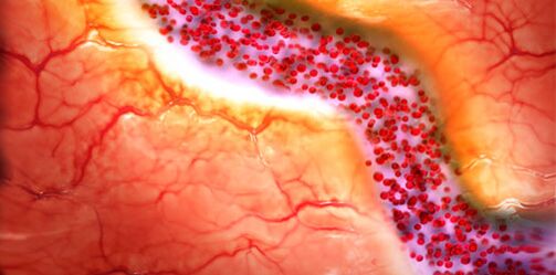 destruction du myocarde par l'alcool